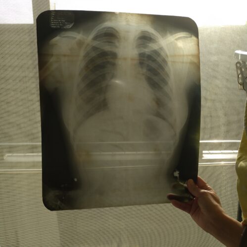 レントゲン写真